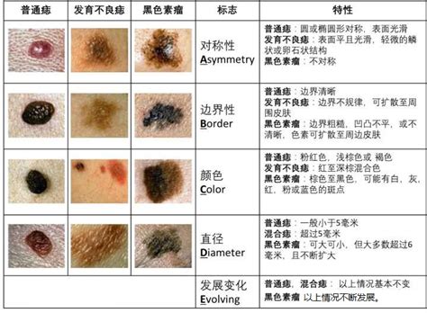 先天性色素痣|先天性黑素细胞痣患者的研究和护理结局共识 